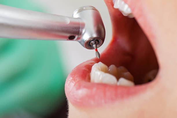 Best Emergency Broken Tooth Repair in Bel Air, MD